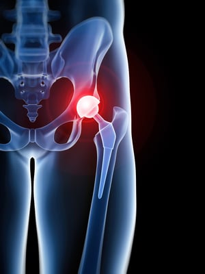 Joint replacement technology